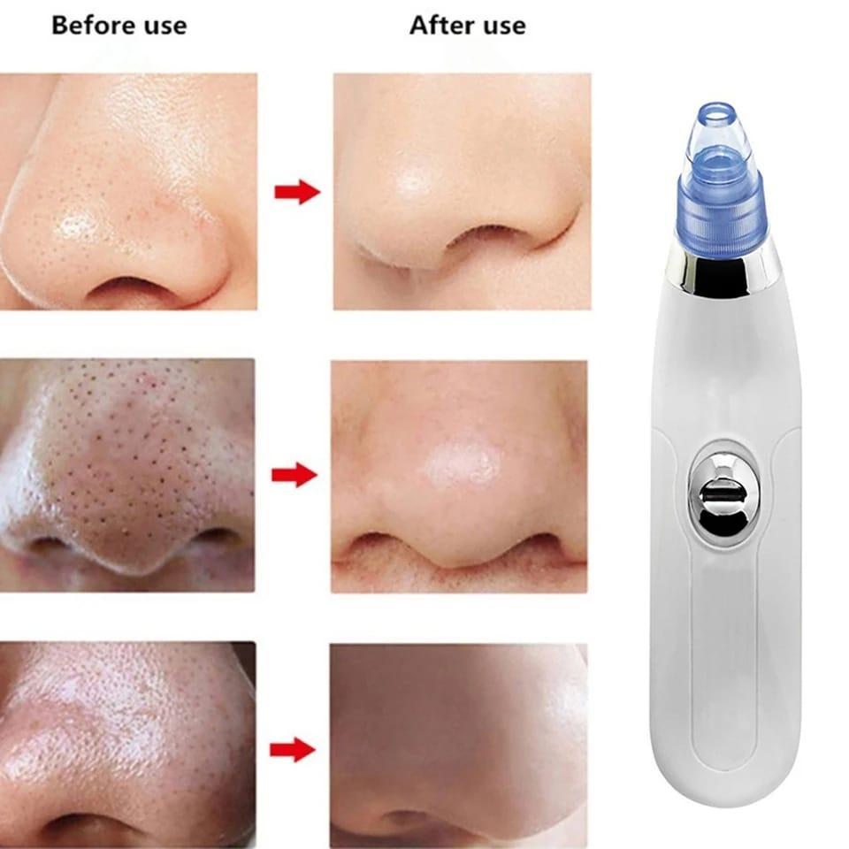 Face Vacuum Suction Blackhead Remover