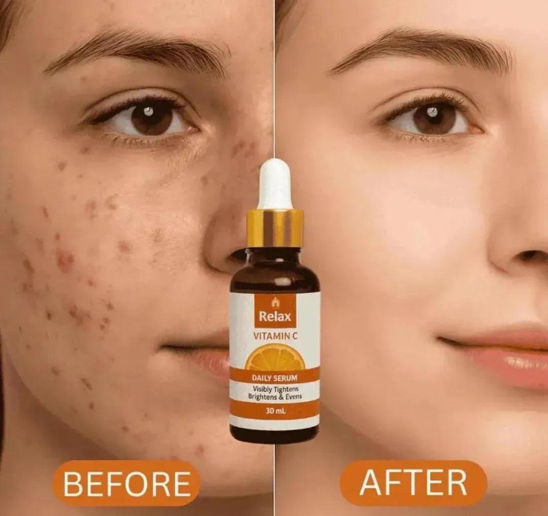Anti-Acne Vitamin C - Serum